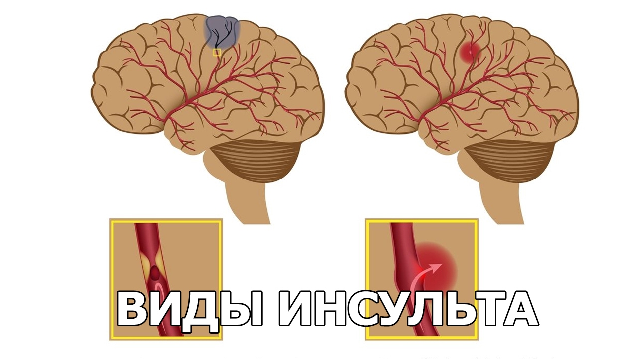 Виды инсульта