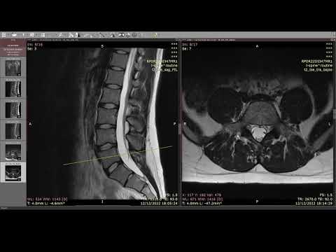 Video: Cómo leer y reconocer resultados de resonancia magnética lumbar normales y anormales