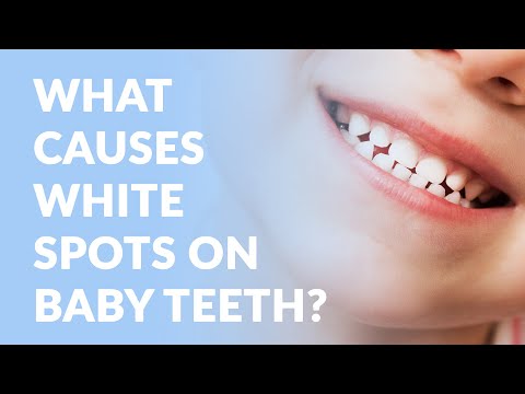 Video: The Reason For The Appearance Of White Spots On The Teeth Of A Child