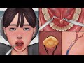 Asmr  salivary gland stones removal animation