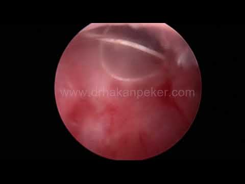 Histeroskopi ile ipi görülmeyen spiralin (Rahim içi araç - RİA) çıkarılması,DR. HAKAN PEKER