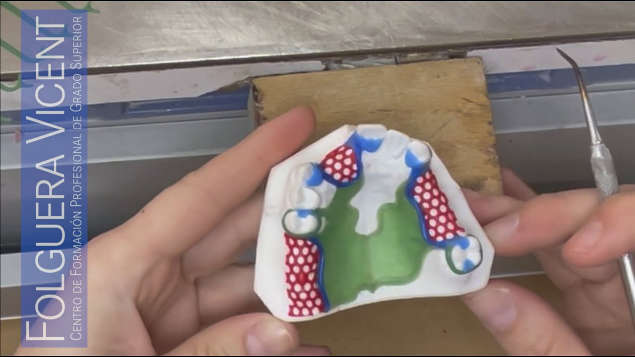 Confección de la estructura en cera, para una prótesis dental parcial removible metálica