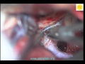 Neurosurgery Video Choroidal Aneurysm