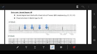 ECG 🔷️Second Degree HB, Fixed ratio block
