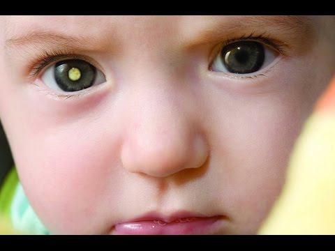 Video: Retinoblastoma (retinoblastoma)