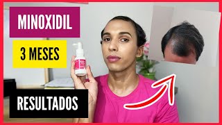 Minoxidil Resultados Nas Entradas do Cabelo