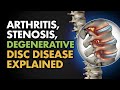 Arthritis, Stenosis, Degenerative Disc Disease Explained