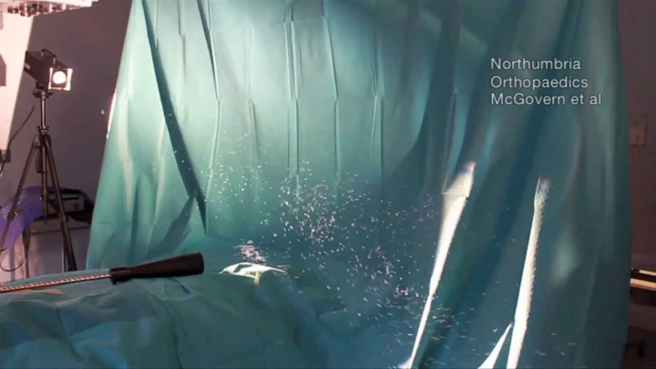 Forced-air Patient Warming Causes Vortex That Deposits Contaminants Within Surgical Field