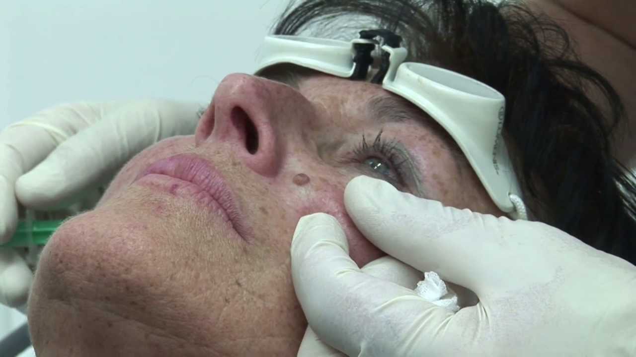 Laserabtragung von Hautmalen  YouTube