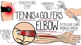 Understanding Tennis Elbow and Golfer's Elbow (Lateral & Medial Epicondylitis)