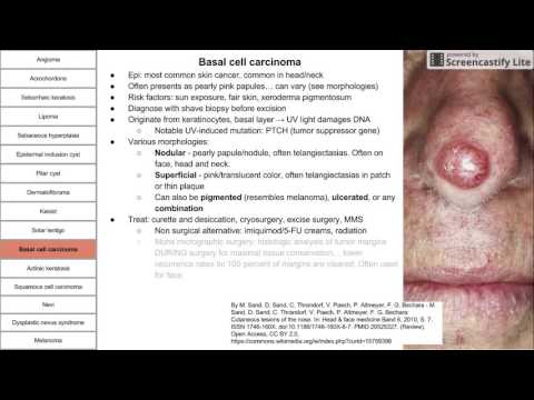 Growths, neoplasms, and cancers of the skin