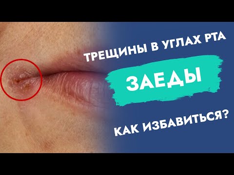 Трещины в углах рта. Заеды. Как избавиться?