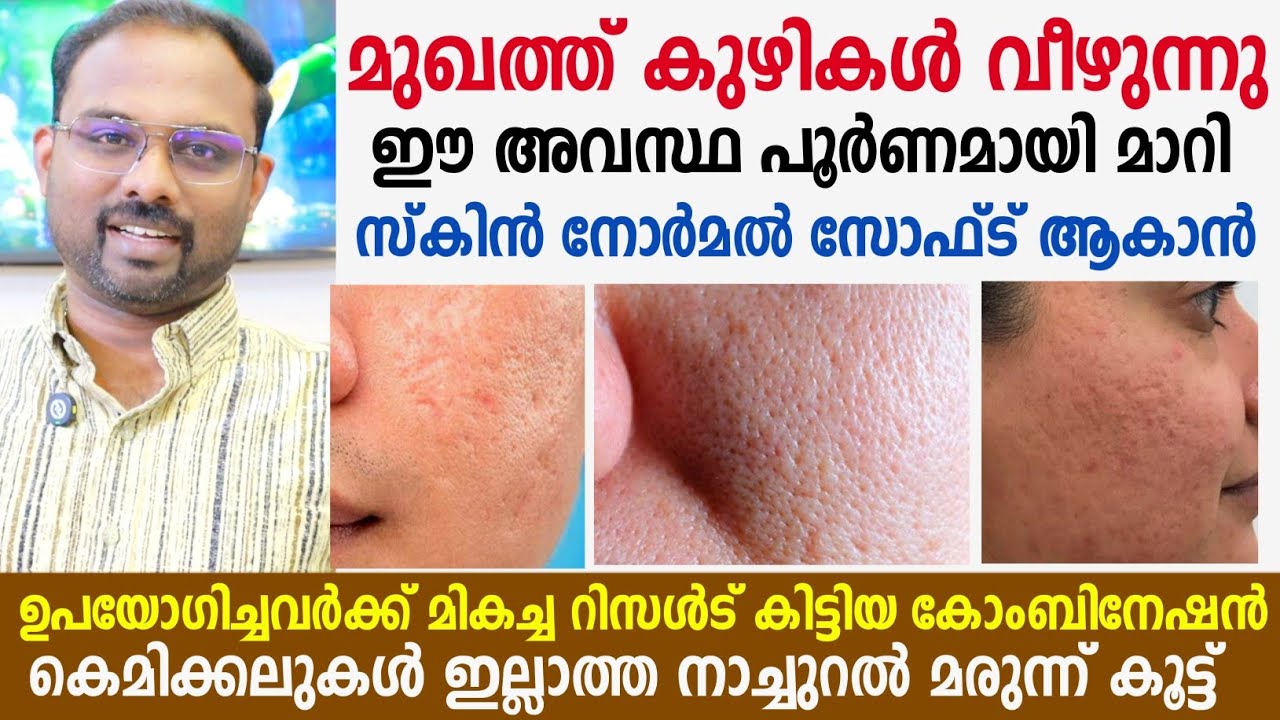 മുഖത്തെ കുഴികളും പാടുകളും പൂർണമായി മാറാൻ നാച്ചുറൽ മരുന്ന് കൂട്ട് 💯Open pores home remedies malayalam