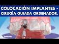 Cirugía guiada por ordenador para colocar implantes dentales ©