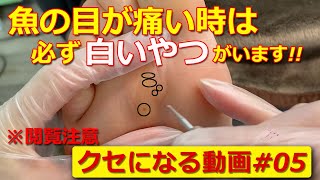 [※閲覧注意]魚の目ケア動画。魚の目の痛みを緩和する。