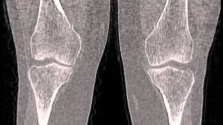видео Компьютерная томография коленного сустава