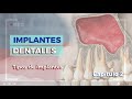 Implantes Dentales Capítulo 2