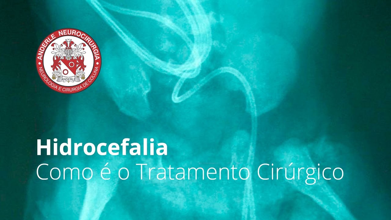 Hidrocefalia Como é o Tratamento Cirúrgico Dr Diogo Neurocirurgião YouTube Hidrocefalia Como é o Tratamento Cirúrgico Dr Diogo Neurocirurgião YouTube
