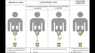 Methods of Urine Collection; Suprapubic Aspiration SPA and Midstream Specimen of Urine MSU