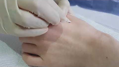 Vivokey Sparkv2 NFC RFID Microchip Implant Procedure!!