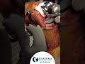 Remarkable Recovery: Knee Surgery Transformation by Dr. I. Satish Raju