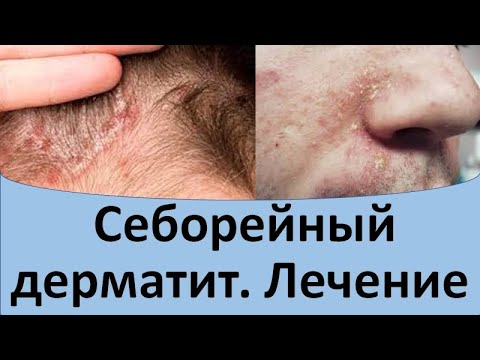 Себорейный дерматит лечение.