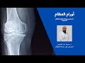 معلومات تهمك عن اورام العظام ح1