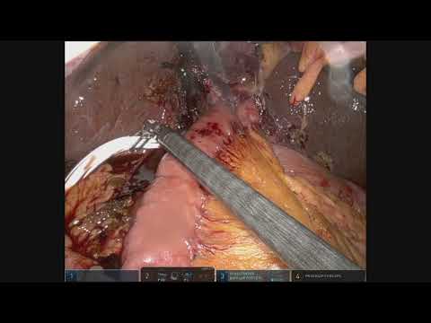 Video thumbnail for Robotic Liver Resection – Hilar Cholangiocarcinoma