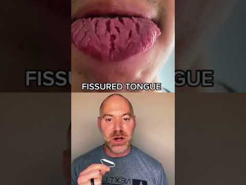 Video: Fissured Tongue: Obrázky, Príznaky, Príčiny A ďalšie