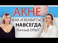 АКНЕ от А до Я. Вебинар с косметологом.