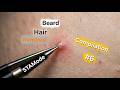 The Most Deep Ingrown Beard Hair Extraction Compilation 😬 #tweezing #beard #plucking | #6