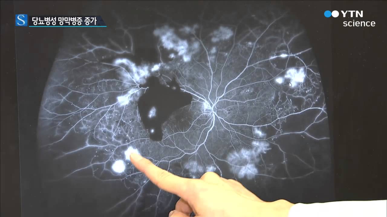 시력 감퇴하는 '당뇨병성 망막병증' 노년층 주의 / YTN 사이언스 - YouTube