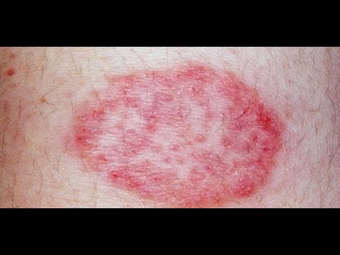 أسباب وجود بقع حمراء على الجلد