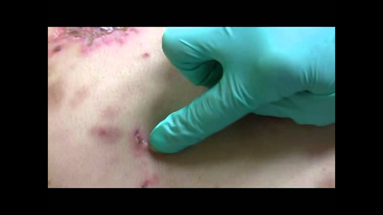 nikolsky sign pemphigus vulgaris nikolsky sign
