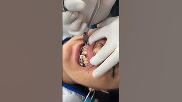 Đi tháo niềng mà rụng cả răng??? #shorts