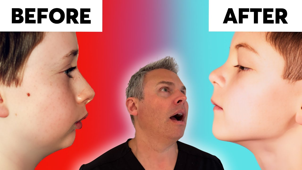 Mouth Breathing is Changing Your Child's Face