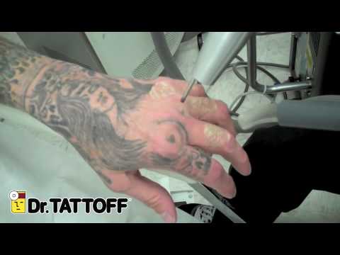 Tattoo Removal - Skull Tattoos on Fingers Removed in Dallas, Texas at Laser  Tattoo Removal Clinic - YouTube