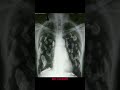 This chest X-ray is telling a story most people miss.Those irregular, thick, #dr_couples143 #chest
