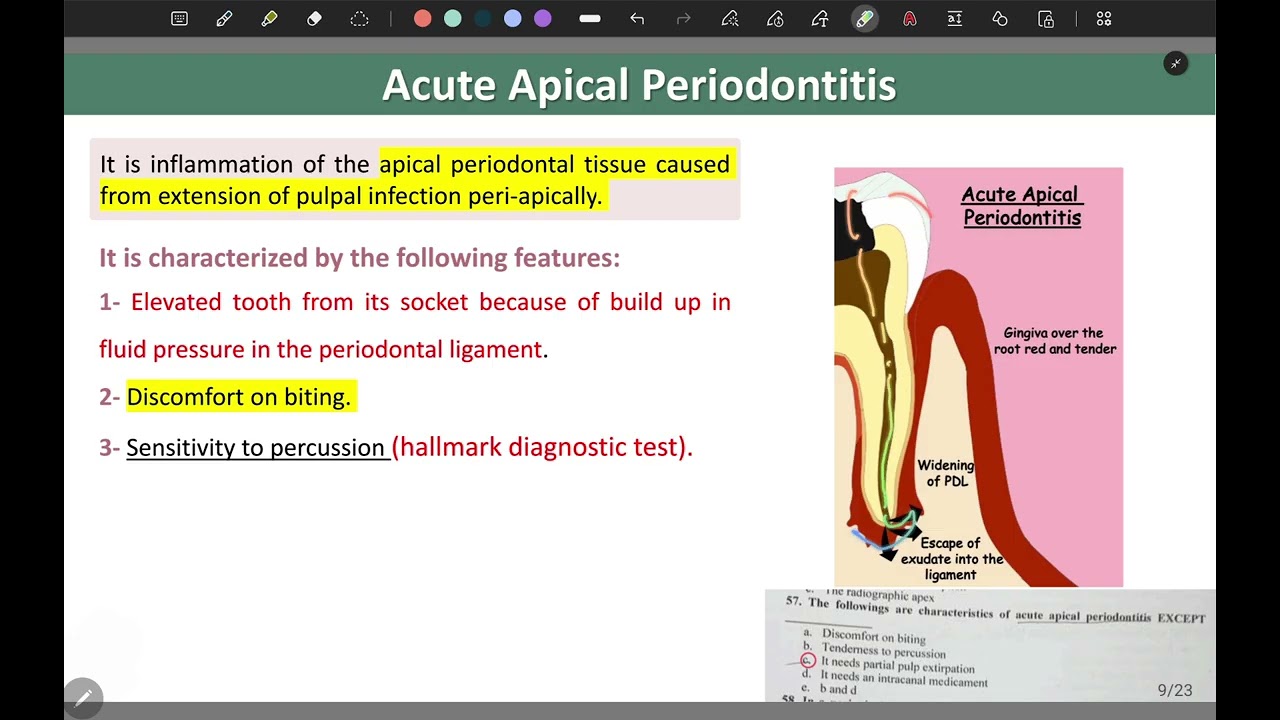 Endodontic emergency treatment |endodontic| fifth stage 