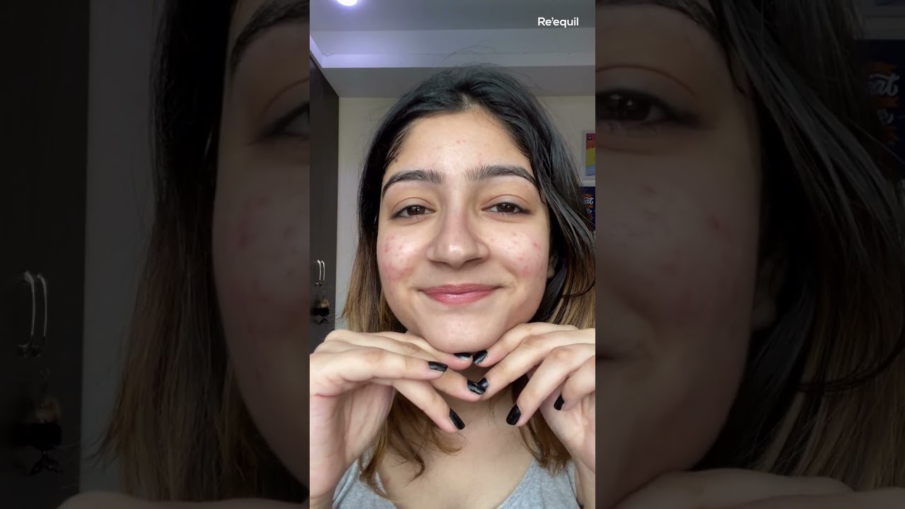 Get rid of stubborn acne scars, marks and pits effectively | See visible results