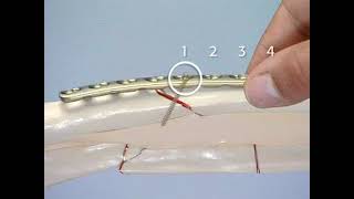 Forearm Shaft Fracture Fixation by LCP