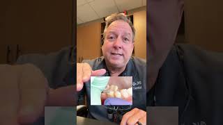 #crownprep #crown #veneer #sameday #dental #dentist #dentistry #tips #fast #preparation #teeth