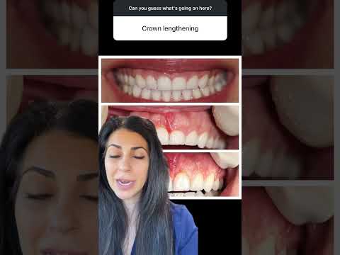 Crown lengthening vs