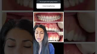 Crown lengthening vs laser gum contouring before and after | Dr. Yazdan | gummy smile procedure