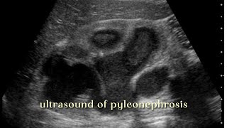 Ultrasound Imaging of Pyelonephrosis: What You Need to Know