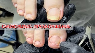 видео: Онихолизис. Продолжение картинка: Онихолизис. Продолжение
