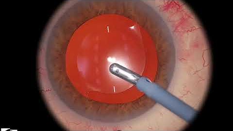 EyeSi CAT C IOL Insertion, Level 8 (correct misplaced toric IOL)