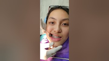 khớp cắn ngược với drphong