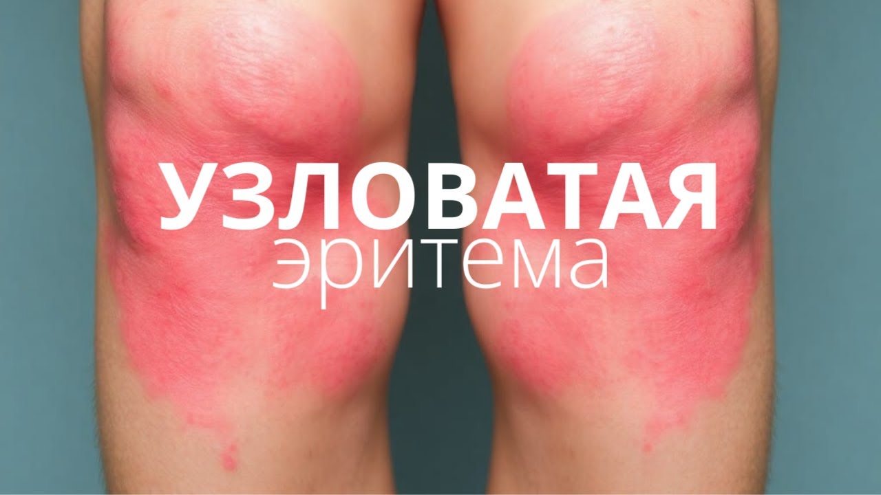 Узловатая Эритема - Определение, Этиология, Классификация, Клиническая картина, Диагностика, Лечение