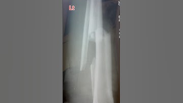 X-ray of leg (tibia and fibula) Ap/Lt view Position Radiology